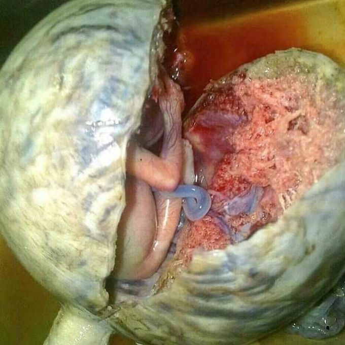 Ectopic pregnancy