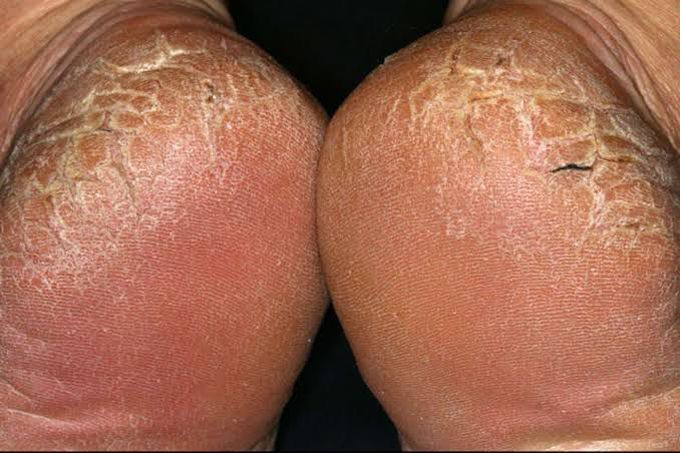 Fissure