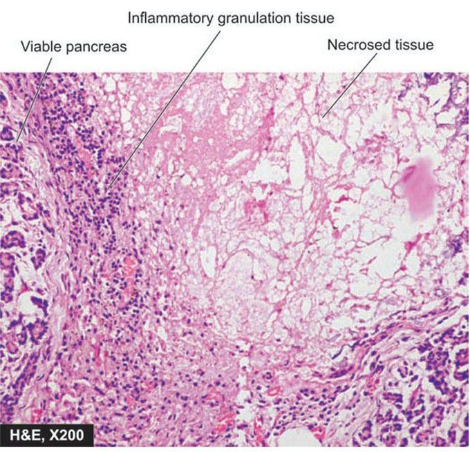 Chronic pancreatitis.