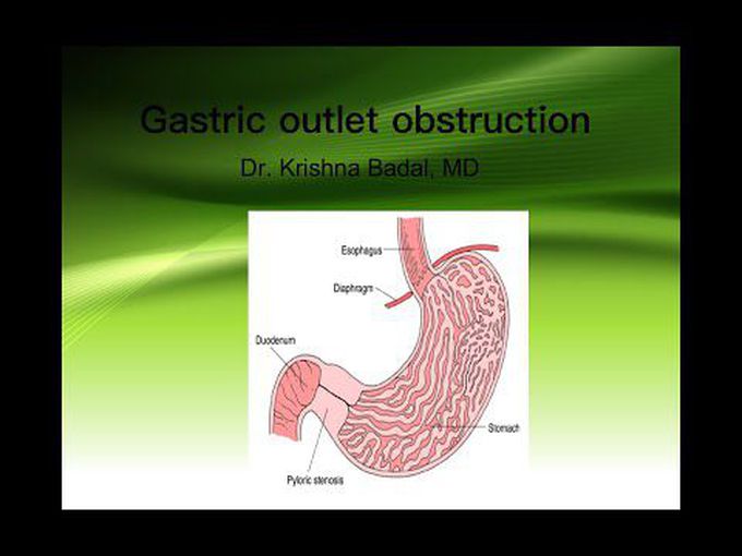 Introduction to Gastric Outlet Obstruction