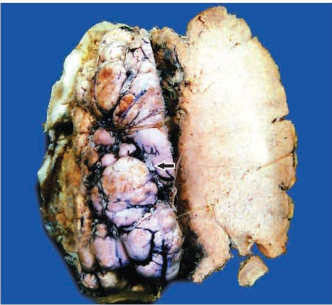 Meningioma