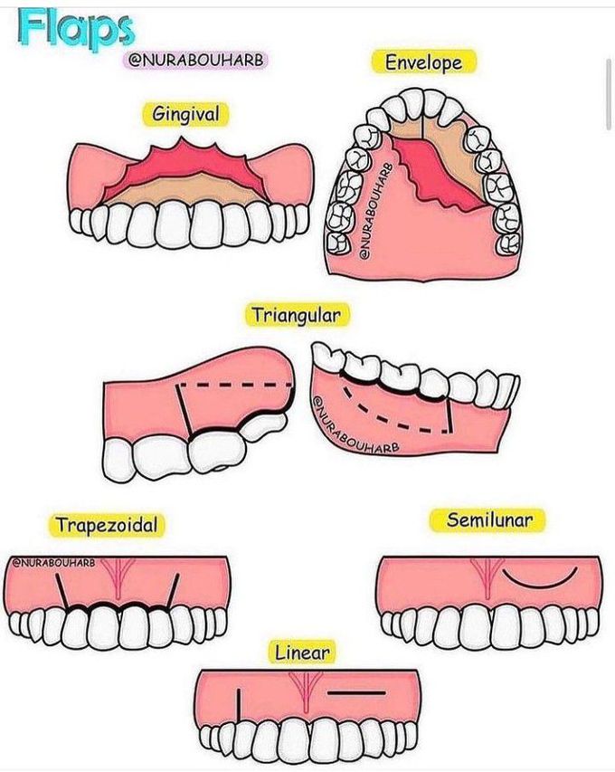 Oral Flaps