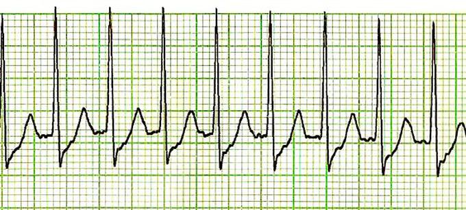 Polyuria and Natriuresis in PSVT