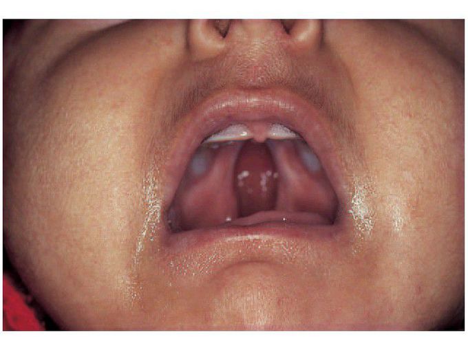 Cleft palate