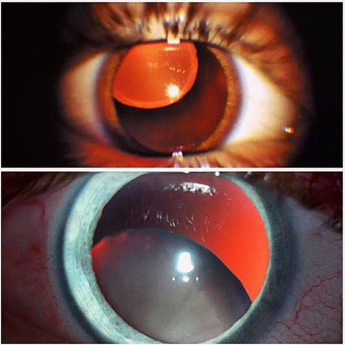 Upward vs. downward lens dislocations!