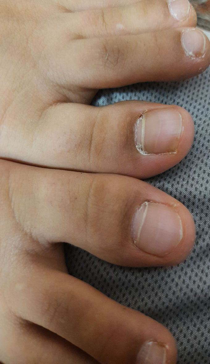 Nail fracture