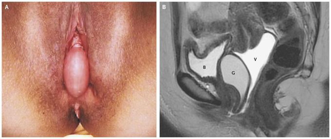 Gartner's Duct Cyst