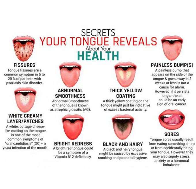 Tongue health - MEDizzy