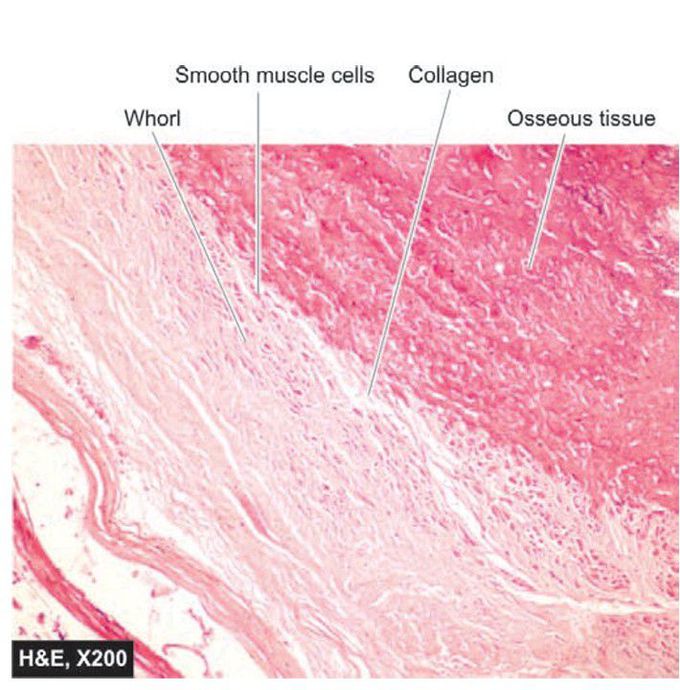 Osseous metaplsia in leiomyoma uterus.