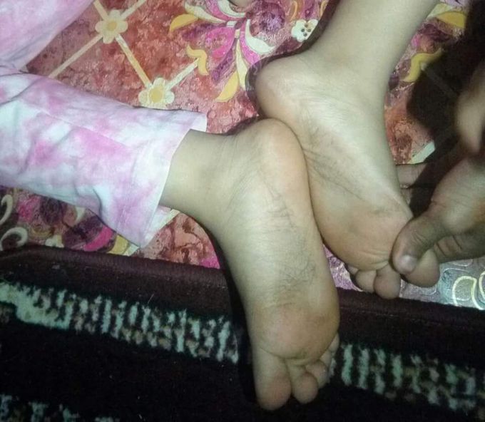 A 7 year old girl developed black marks on her both feets after one year she started to fell itching in these area what is the possible diagnosis