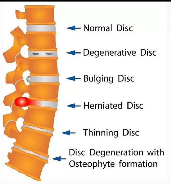 Disc Changes