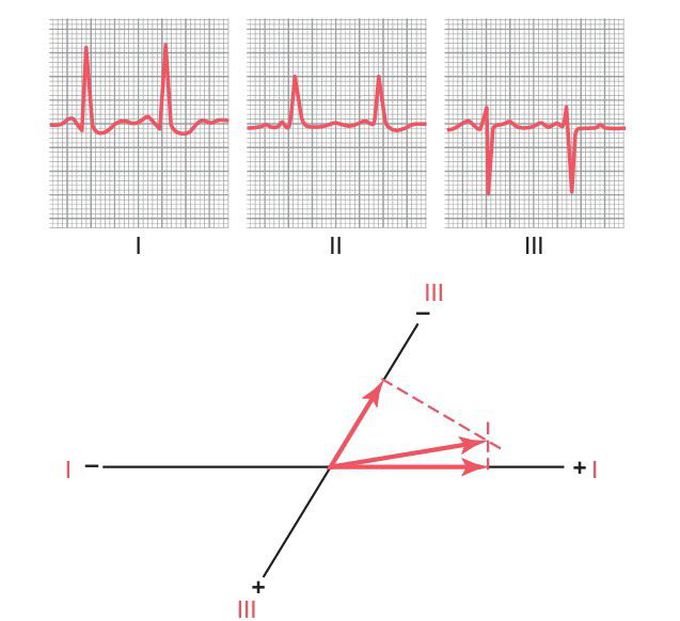 Hypertrophic left ventricle