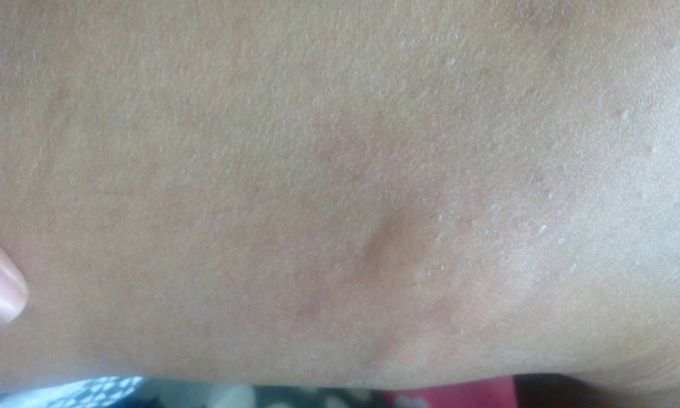 Chronic urticaria treatment?