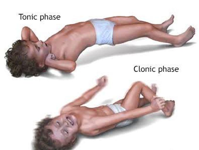 What are febrile seizures?