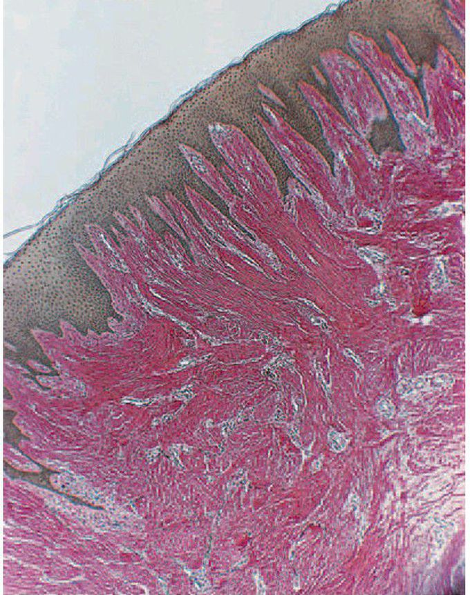 Gingival fibromatosis