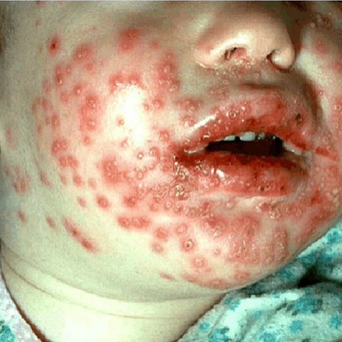 Herpes simplex virus