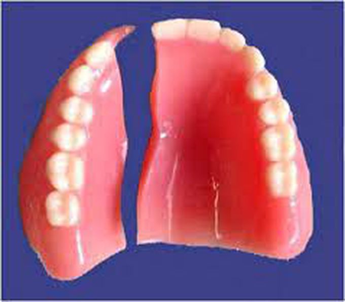 Advantages of denture rebasing