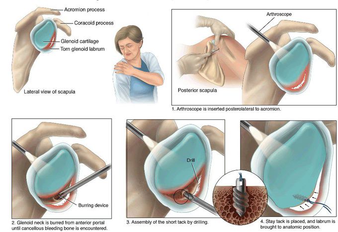 Treatment for Bankart Lesion