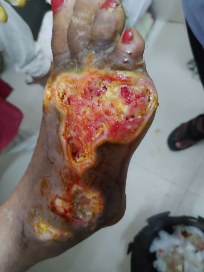 Diabetic foot😳😳😳