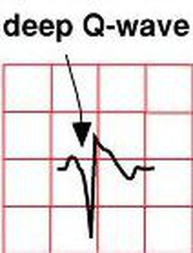 Electrocardiogram
