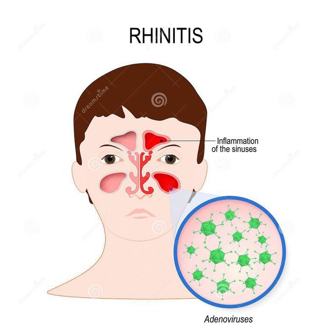 Viral sinusitis