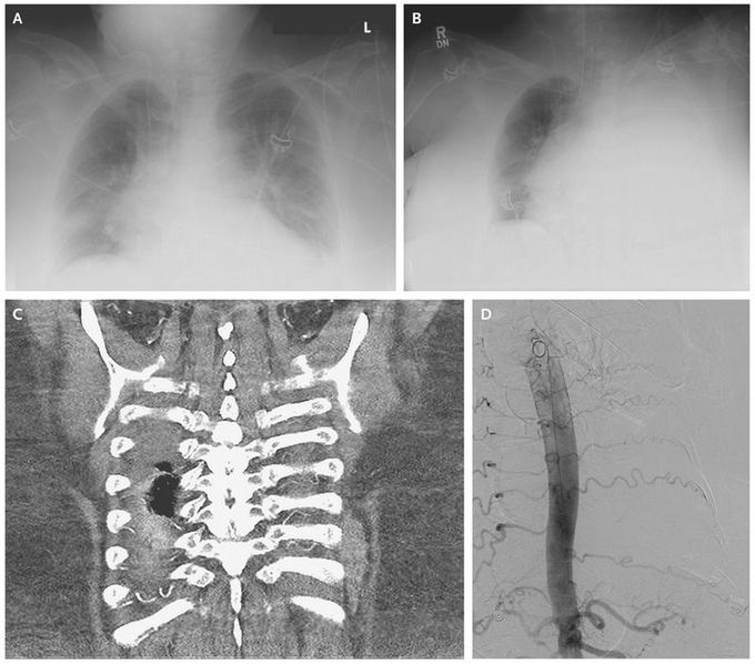 Hemothorax after Thoracentesis