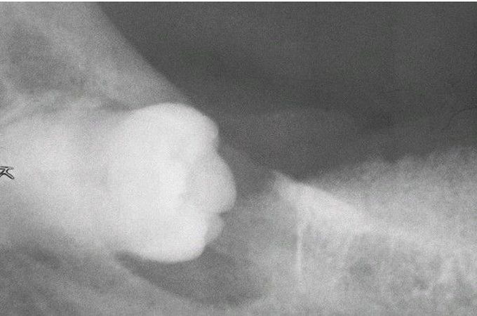 Carcinoma Arising in a Dentigerous Cyst.