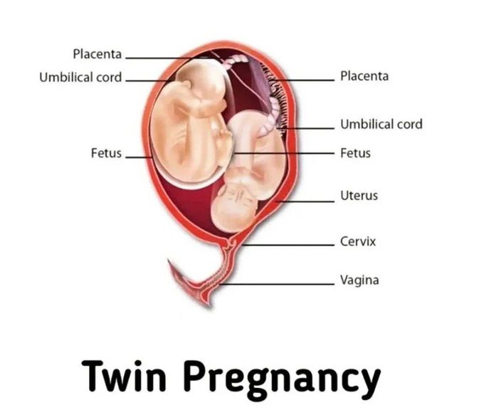 Twin Pregnancy