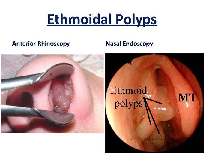 Endoscopy and anterior rhinoscopy views of the Nasal Polyps