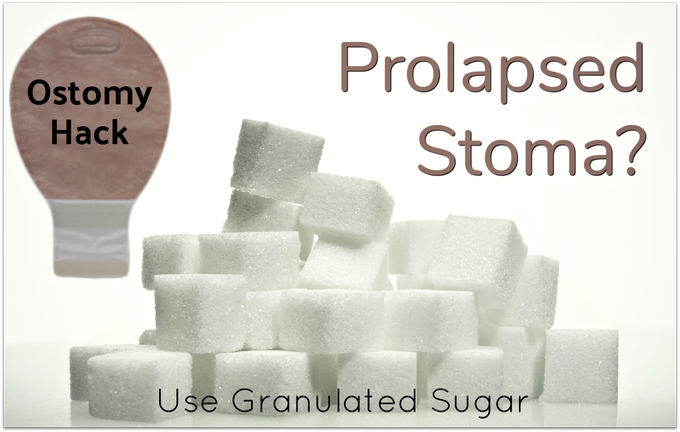 Fix A Prolapsed Stoma with this Easy Trick.