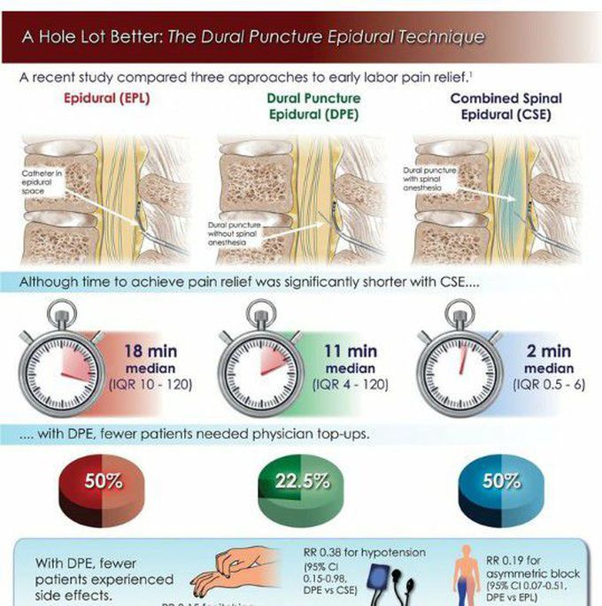 DURAL PUNCTURE EPIDURAL TECHNIQUE