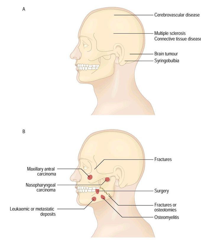 Causes of sensory loss