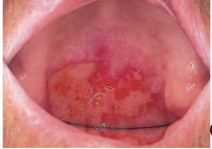 Mucous membrane pemphigoid