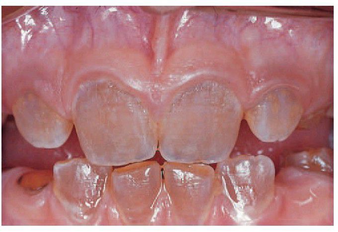 Dentinogenesis imperfecta
