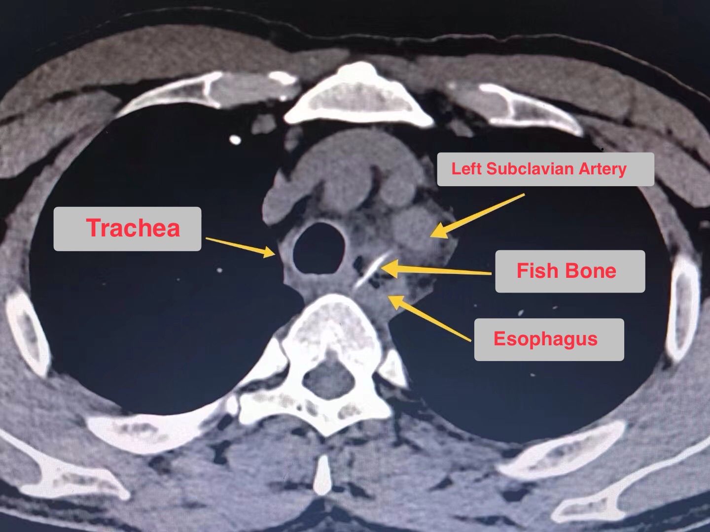 Foreign body on CT scan - MEDizzy