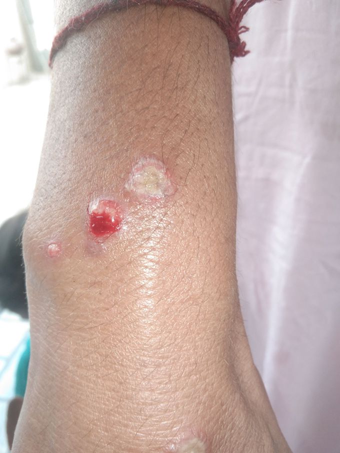 Pt starting with blisters now this plz dx and treatment ??