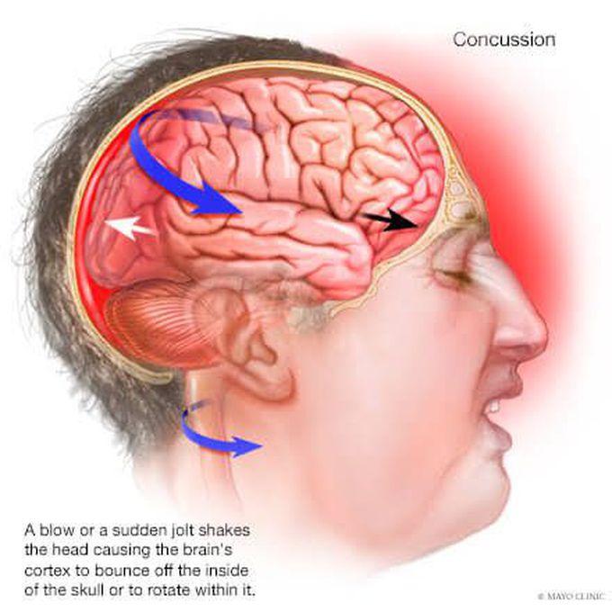 Risk factors of concussion