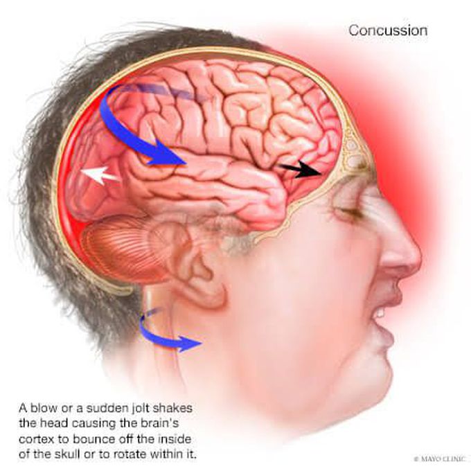 risk-factors-of-concussion-medizzy