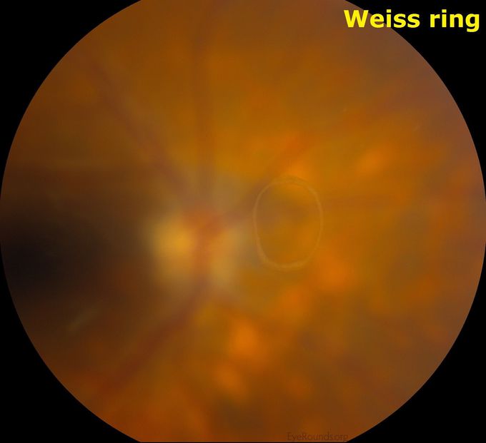 Weiss ring
