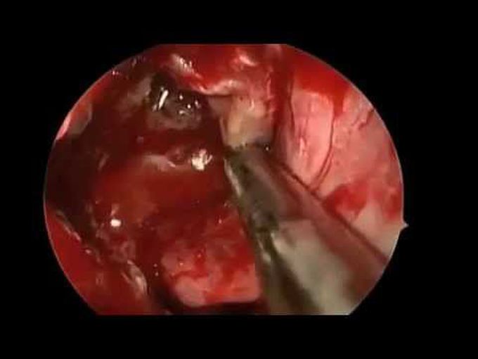 Expanded Endoscopic Endonasal Transcribriform Approach for Anterior Skull Base Olfactory Schwannoma