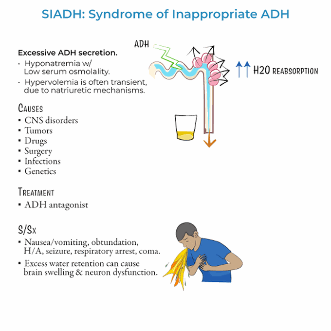 Syndrome of inappropriate ADH (SIADH)