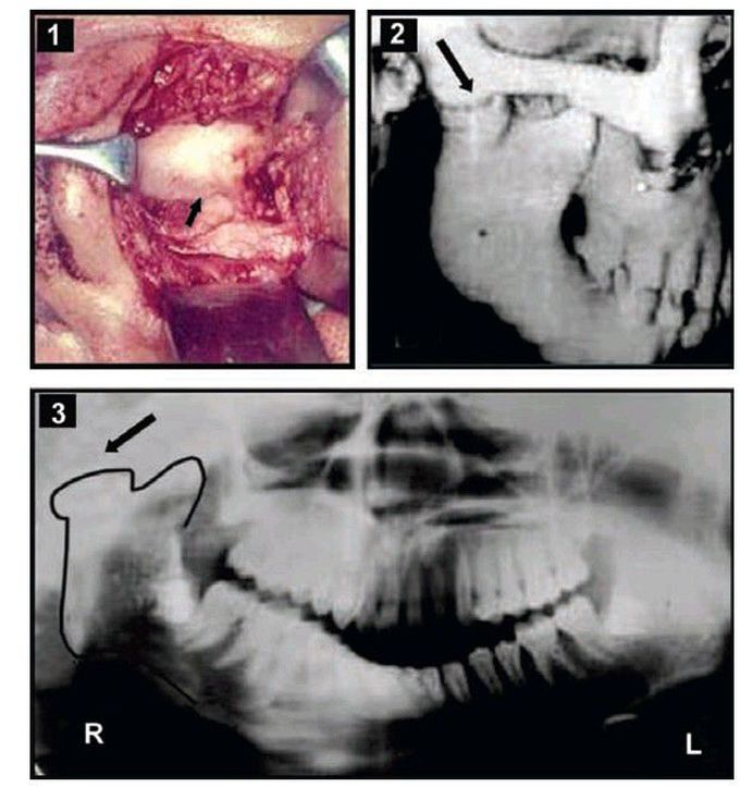 Bony ankylosis