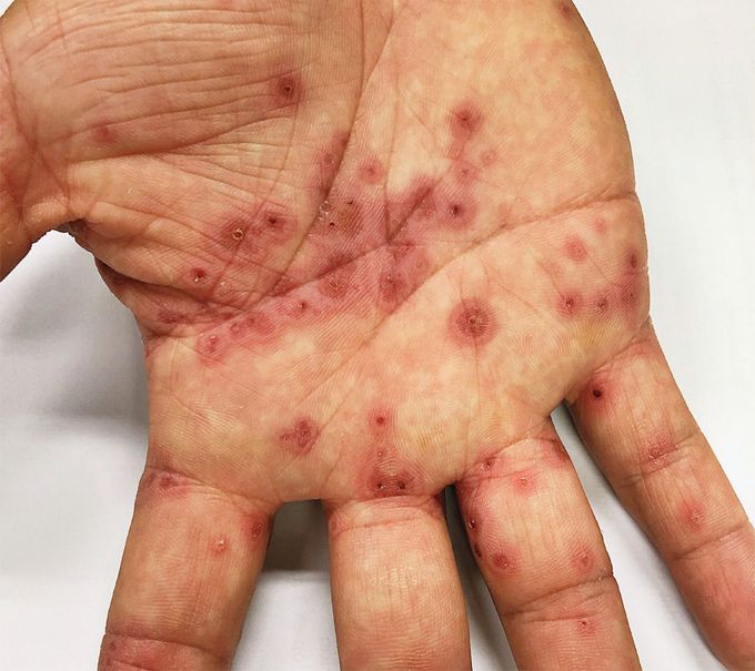 Herpes-Associated Erythema Multiforme