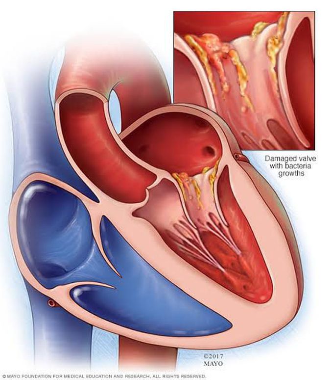 Endocarditis