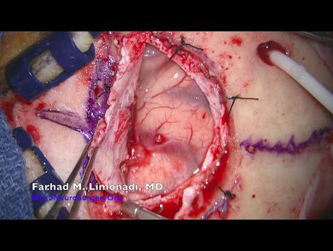 Brain Surgery : Large tumor resection from lateral ventricle by transcallosal inter-hemispheric...