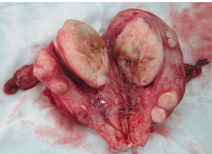 Uterine Fibroids