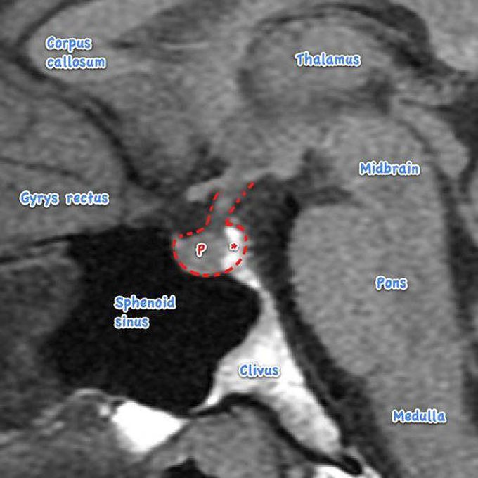 Pituitary gland