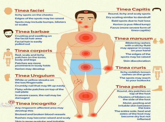 Varieties of Tinea Capitis - MEDizzy