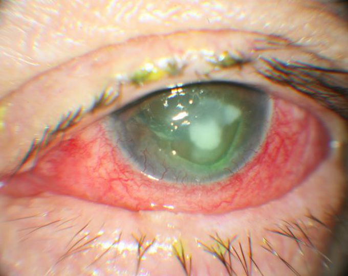 Fungal Eye Infections