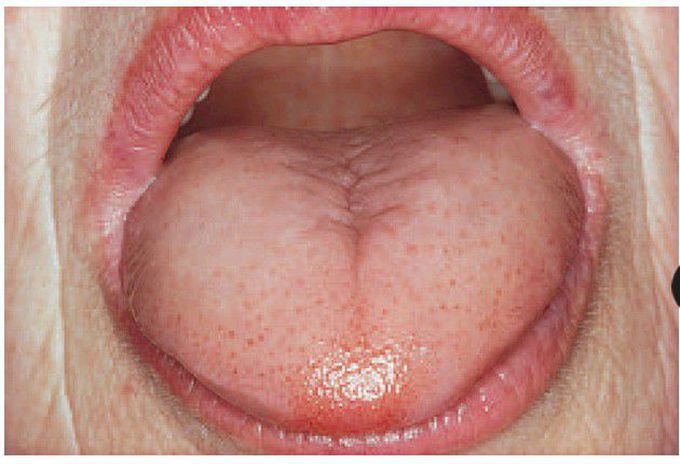 Pernicious anaemia